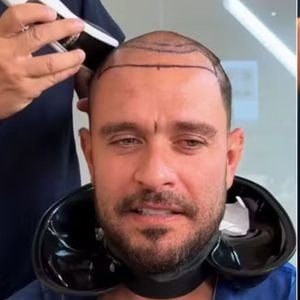 Diogo Nogueira traz à tona como o implante capilar utiliza fios do próprio
paciente.