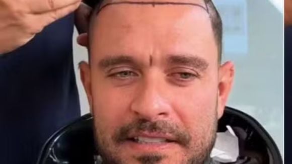 Diogo Nogueira raspa o cabelo e levanta suspeita de novo transplante capilar; especialista detalha procedimento, cada vez mais popular em famosos: 'Deixou de ser tabu'