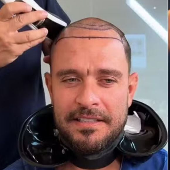 Diogo Nogueira traz à tona como o implante capilar utiliza fios do próprio
paciente.
