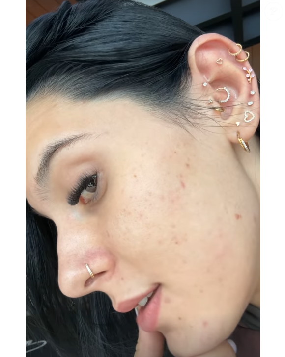 A boiadeira não compartilhou detalhes sobre a duração do tratamento, que costuma variar entre quatro e oito meses, dependendo da dose e da resposta individual de cada paciente. A escolha, embora comum entre jovens e adultos com acne persistente, exige atenção.