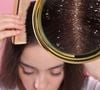 Cabelo com caspa no verão: é verdade que lavar o cabelo todo dia piora a doença? Veja o que dizem especialistas!