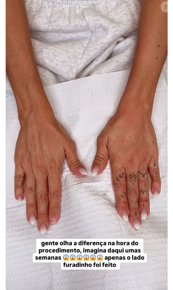 "Trata-se de uma das regiões que mais denunciam o envelhecimento, ao lado do colo e da face. Por isso, o cuidado com o dorso das mãos, e até mesmo com os dedos, tem se tornado uma preocupação crescente entre os pacientes", diz a médica