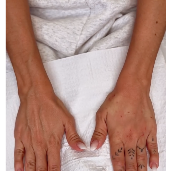 "Trata-se de uma das regiões que mais denunciam o envelhecimento, ao lado do colo e da face. Por isso, o cuidado com o dorso das mãos, e até mesmo com os dedos, tem se tornado uma preocupação crescente entre os pacientes", diz a médica