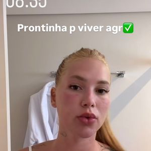 Virginia Fonseca mostrou aos seguidores como ficou seu rosto após passar por tratamento a laser