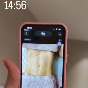 Virgínia Fonseca também é adepta dos procedimentos estéticos