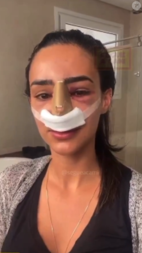 Bruna Biancardi se submeteu à uma cirurgia de rinoplastia em 2018.