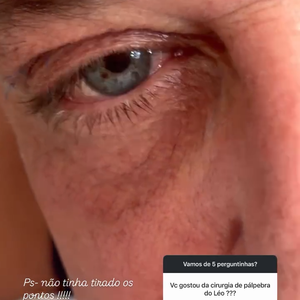 ‘Realçou a cor dos olhos’, elogiou Poliana Rocha após a blefaroplastia de Leonardo