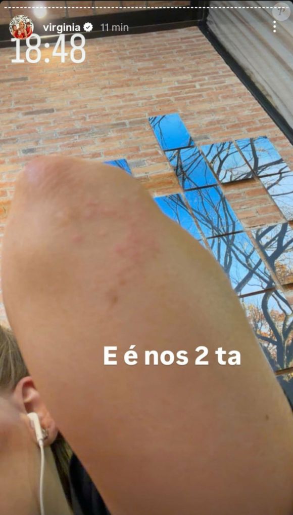 Virgínia mostrou que a região do seu cotovelo está bem irritada devido aos problemas emocionais