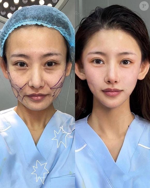 Dr. Lifeng também fez incisões próximas à orelha, que são as mais comuns no facelift