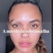 Calvície na sobrancelha: Giovana Cordeiro, de 'Dona de Mim', revela diagnóstico incomum por uso de muita química nos pelos; dermatologista explica