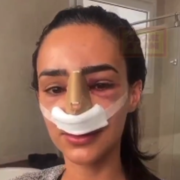 Bruna Biancardi fez a rinoplastia em 2018, junto com uma correção de desvio de septo