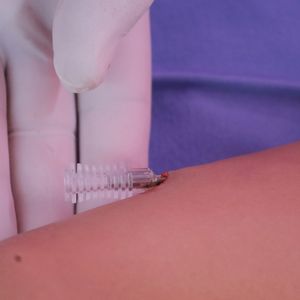 O chip hormonal é um implante subcutâneo que libera hormônios de forma contínua e é mais conhecido como método contraceptivo. Neste caso, é utilizado progesterona