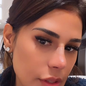 O perfil de Simone Mendes evidencia a ponta do nariz mais elevada após procedimento com fios, técnica escolhida para evitar uma rinoplastia