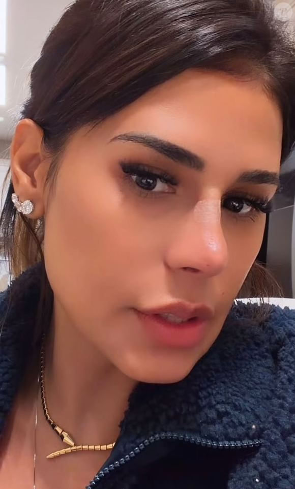 O perfil de Simone Mendes evidencia a ponta do nariz mais elevada após procedimento com fios, técnica escolhida para evitar uma rinoplastia