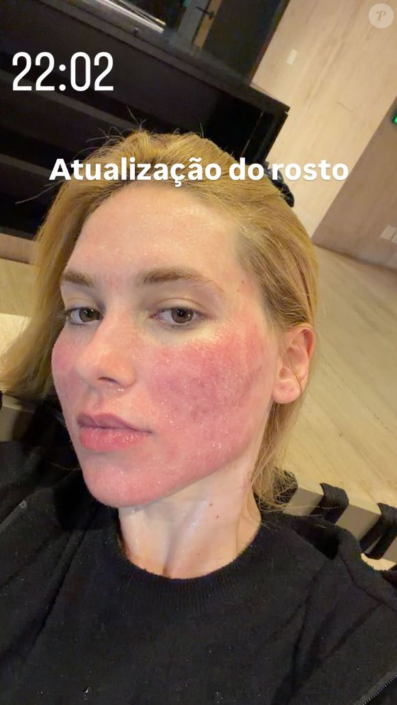 Virgínia está com o rosto vermelho e levemente inchado, o que é comum para pacientes que passam pelo procedimento