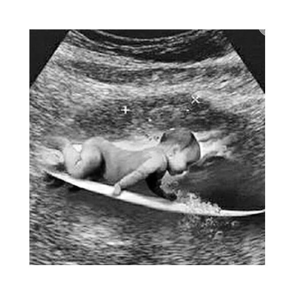 Gabriel Medina publicou uma montagem de um ultrassom, que mostra um bebê com uma prancha