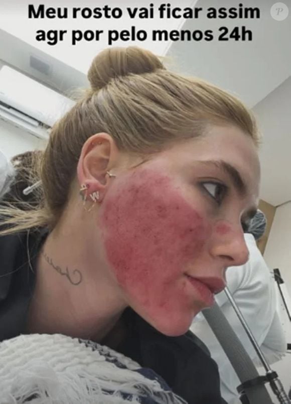 Aparência de Virgínia Fonseca após procedimento facial gera dúvidas na web; influenciadora explica que reação era esperada e temporária