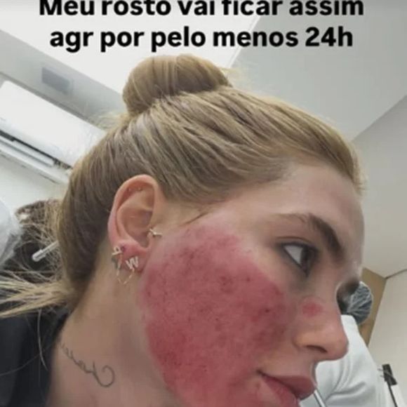 Aparência de Virgínia Fonseca após procedimento facial gera dúvidas na web; influenciadora explica que reação era esperada e temporária