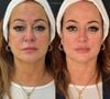 Antes e depois Nadine Gonçalves: mãe de Neymar paga R$ 25 mil em rejuvenescimento facial e surpreende
