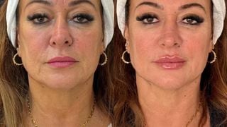 Antes e depois Nadine Gonçalves: mãe de Neymar paga R$ 25 mil em rejuvenescimento facial e resultado surpreende