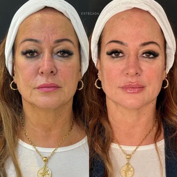 Antes e depois Nadine Gonçalves: mãe de Neymar paga R$ 25 mil em rejuvenescimento facial e surpreende