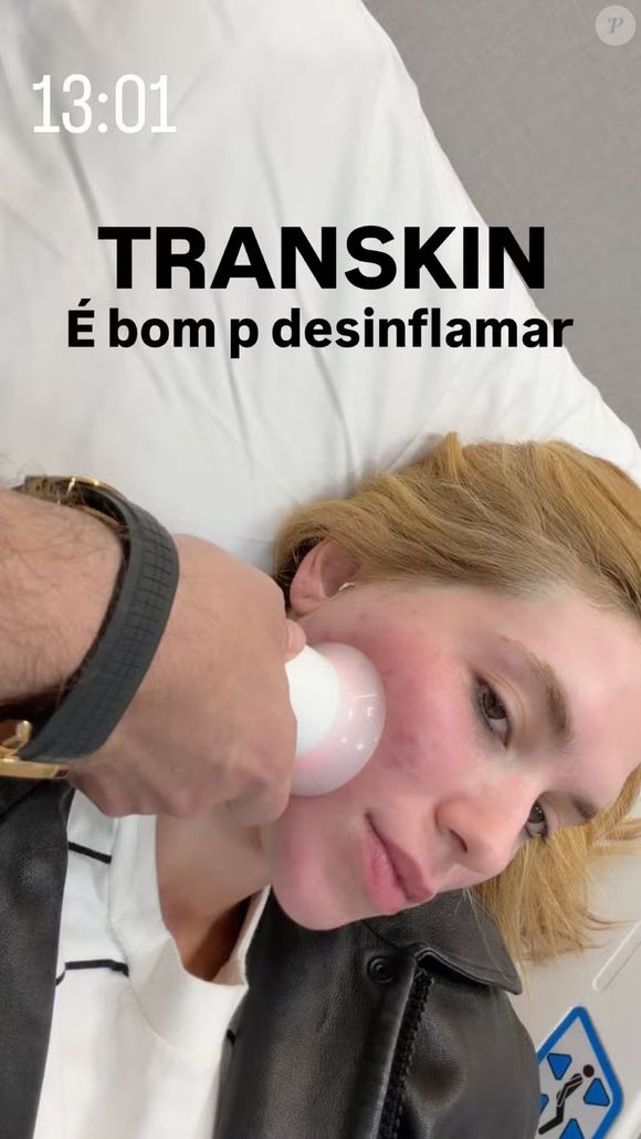 Virgínia aplicou o UltraPulse Alpha, um laser de CO₂ de alta potência, subcisão e exossomos vegetais