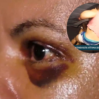 Agredida com 61 socos em elevador mostra rosto machucado e diz que namorado queria matá-la: 'Tentei me manter viva'