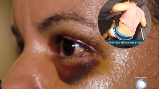 Agredida com 61 socos em elevador mostra rosto machucado e diz que namorado queria matá-la: 'Tentei me manter viva'