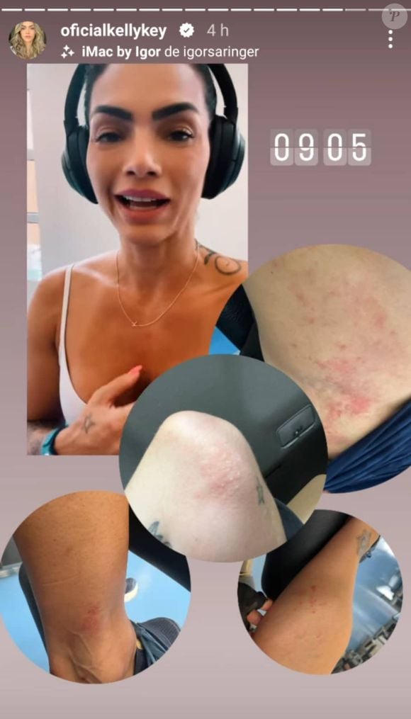 Kelly Key convive com a psoríase, uma doença de pele inflamatória imunomediada, sem cura e não contagiosa