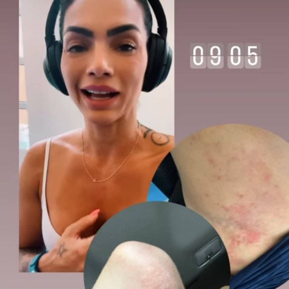 Kelly Key convive com a psoríase, uma doença de pele inflamatória imunomediada, sem cura e não contagiosa