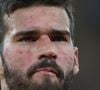 O que é a vermelhidão no rosto de Alisson Becker, o goleiro do Brasil na Copa 2026? Doença crônica não tem cura, aponta médica especialista - na foto, jogador durante a Copa 2018
