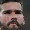 O que Alisson tem no rosto? Doença crônica sem cura afeta pele do goleiro do Brasil na Copa 2026; médico explica diagnóstico e aponta cuidado especial: 'Protetor solar'