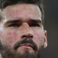 O que Alisson tem no rosto? Doença crônica sem cura afeta pele do goleiro do Brasil na Copa 2026; médico explica diagnóstico e aponta cuidado especial: 'Protetor solar'