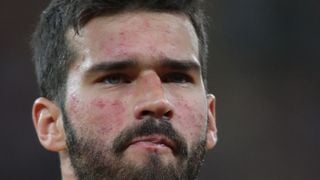 O que Alisson tem no rosto? Doença crônica sem cura afeta pele do goleiro do Brasil na Copa 2026; médico explica diagnóstico e aponta cuidado especial: 'Protetor solar'