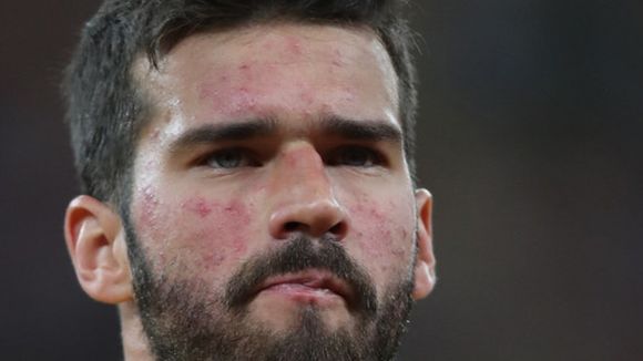 O que Alisson tem no rosto? Doença crônica sem cura afeta pele do goleiro do Brasil na Copa 2026; médico explica diagnóstico e aponta cuidado especial: 'Protetor solar'
