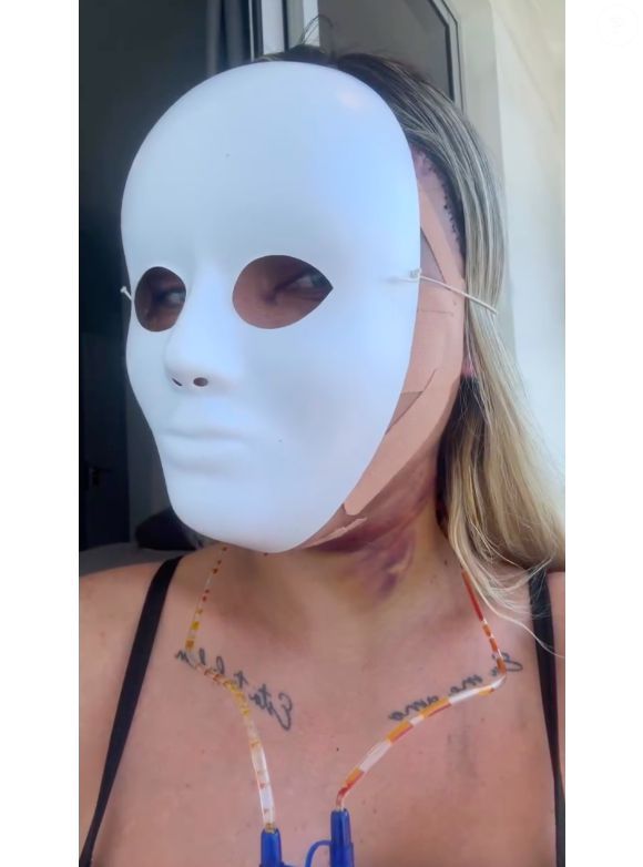 Cirurgia feita por Andressa Urach reposiciona os músculos do rosto, promovendo o rejuvenescimento