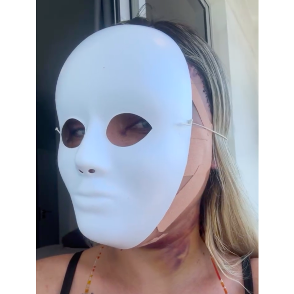 Cirurgia feita por Andressa Urach reposiciona os músculos do rosto, promovendo o rejuvenescimento