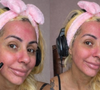 Miss Bumbum expõe reação alérgica após usar sangue da menstruação como skin care; médica aponta riscos de infecção e agravamento de acne