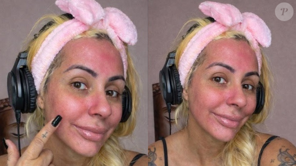 Miss Bumbum expõe reação alérgica após usar sangue da menstruação como skin care; médica aponta riscos de infecção e agravamento de acne