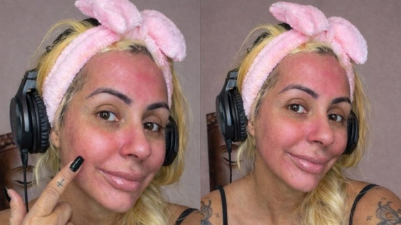 Miss Bumbum expõe reação alérgica após usar sangue da menstruação como skin care; médica aponta riscos de infecção e agravamento de acne