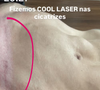 Em seu perfil no Instagram, ela compartilhou com os seguidores o resultado de um procedimento estético voltado para o tratamento de cicatrizes.