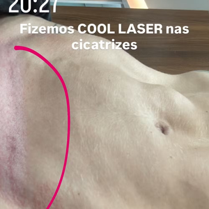 Em seu perfil no Instagram, ela compartilhou com os seguidores o resultado de um procedimento estético voltado para o tratamento de cicatrizes.