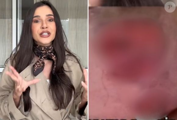 Gizelly Bicalho revela silicone malsucedido e exibe imagem chocante do resultado estético nas redes sociais