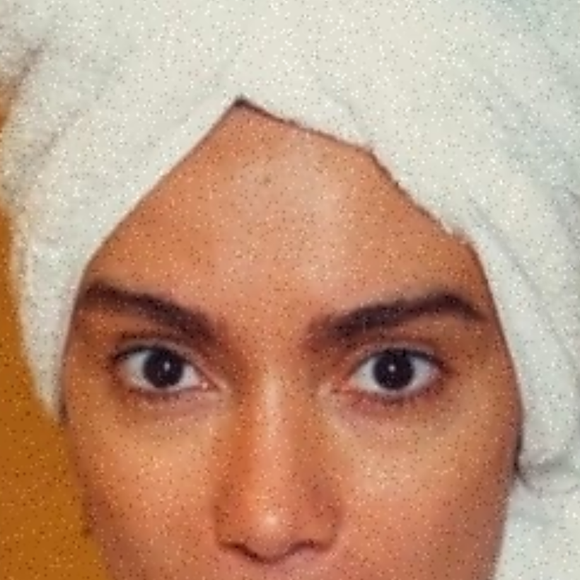 Anitta fez transplante de sobrancelhas? Procedimento no rosto vira febre entre famosas que buscam valorizar olhar e médicos explicam: 'Transformação visível no mesmo dia'