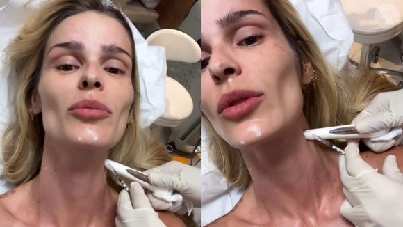 Yasmin Brunet aposta no ‘Botox Nefertiti’ para realçar a mandíbula e rejuvenescer o pescoço