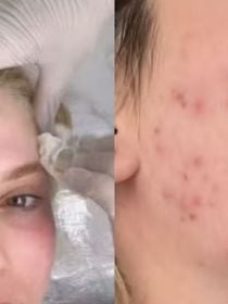 ‘Sai sangue’: Virginia Fonseca expõe acne severa ao resgatar foto antiga e revela tratamento intenso para evitar marcas no rosto