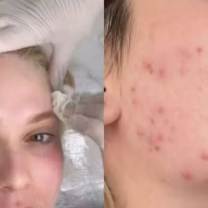 Virginia Fonseca resgatou uma foto de 2023 e mostrou como a pele ficou afetada após o uso de hormônios