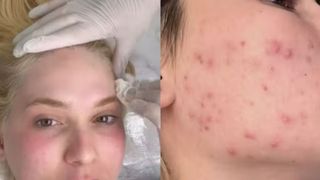 ‘Sai sangue’: Virginia Fonseca expõe acne severa ao resgatar foto antiga e revela tratamento intenso para evitar marcas no rosto