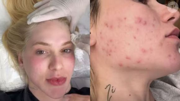 Virginia Fonseca resgatou uma foto de 2023 e mostrou como a pele ficou afetada após o uso de hormônios