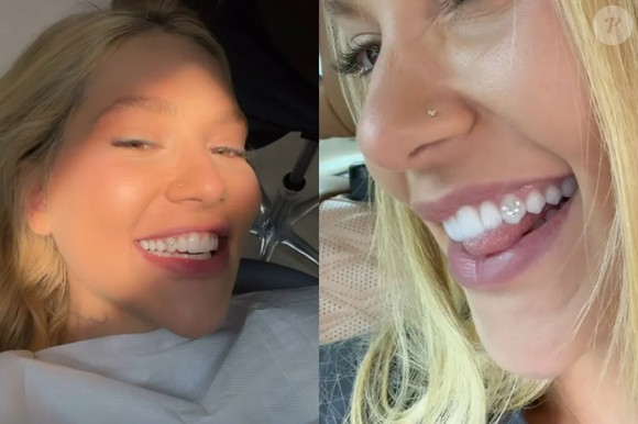 De acordo com a Coluna Veja Gente, o especialista Leonardo Acioli destaca que a aplicação de um tooth gem não deve ser encarada como um procedimento que termina no momento em que a joia é colocada, já que é necessário acompanhar como o dente e a gengiva respondem ao acessório